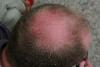 Dirk's sunburn.